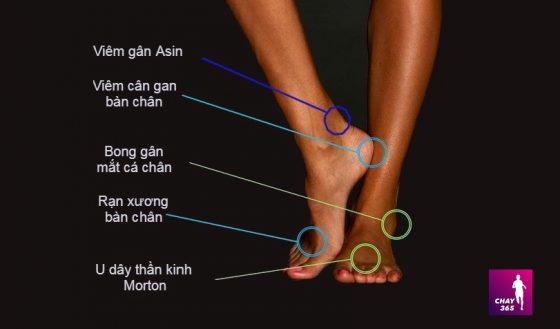 5 chấn thương bàn chân thường gặp khi chạy bộ